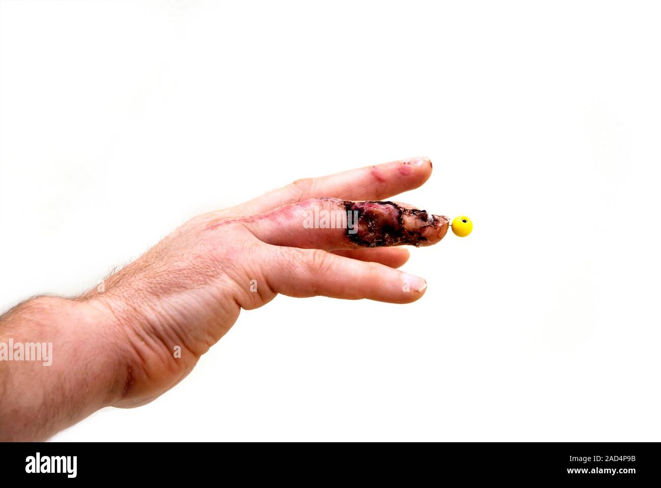 Pinned finger fracture. The fracture is to the distal phalanx bone at