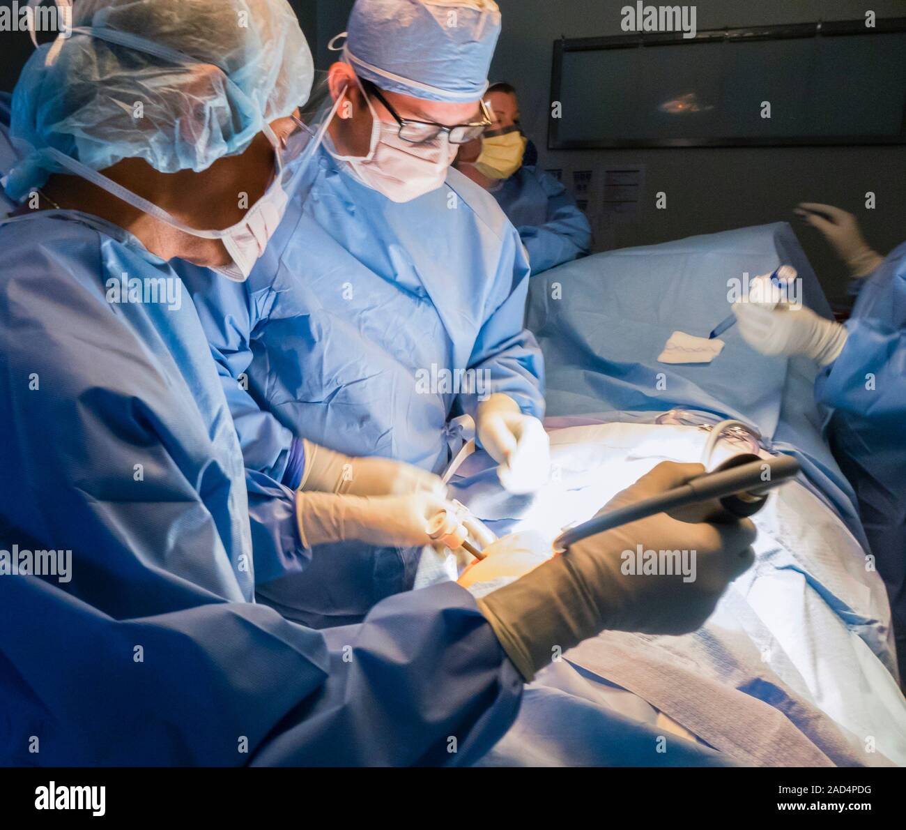 Appendix removal surgery. Surgeon making an incision to insert a trocar during laparoscopic