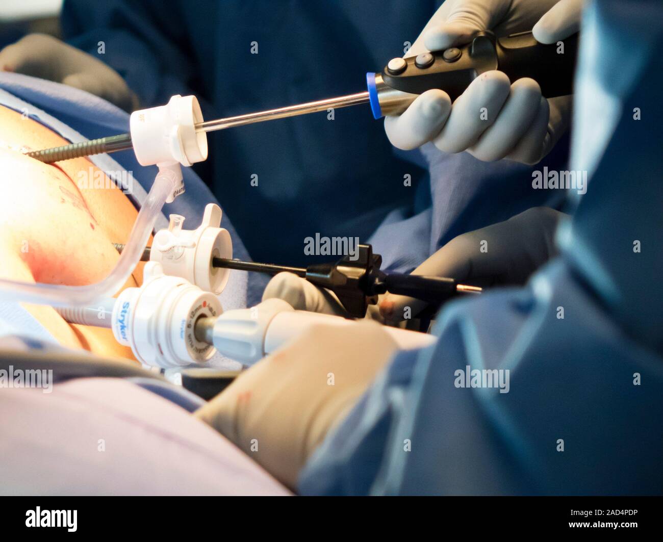Appendix removal surgery. Surgeons performing a laparoscopic (keyhole) appendectomy (removal of