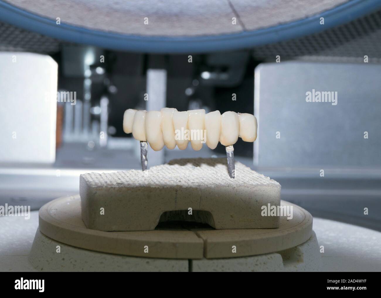 Dental bridge construction. Dental bridge that is being assembled in a ...