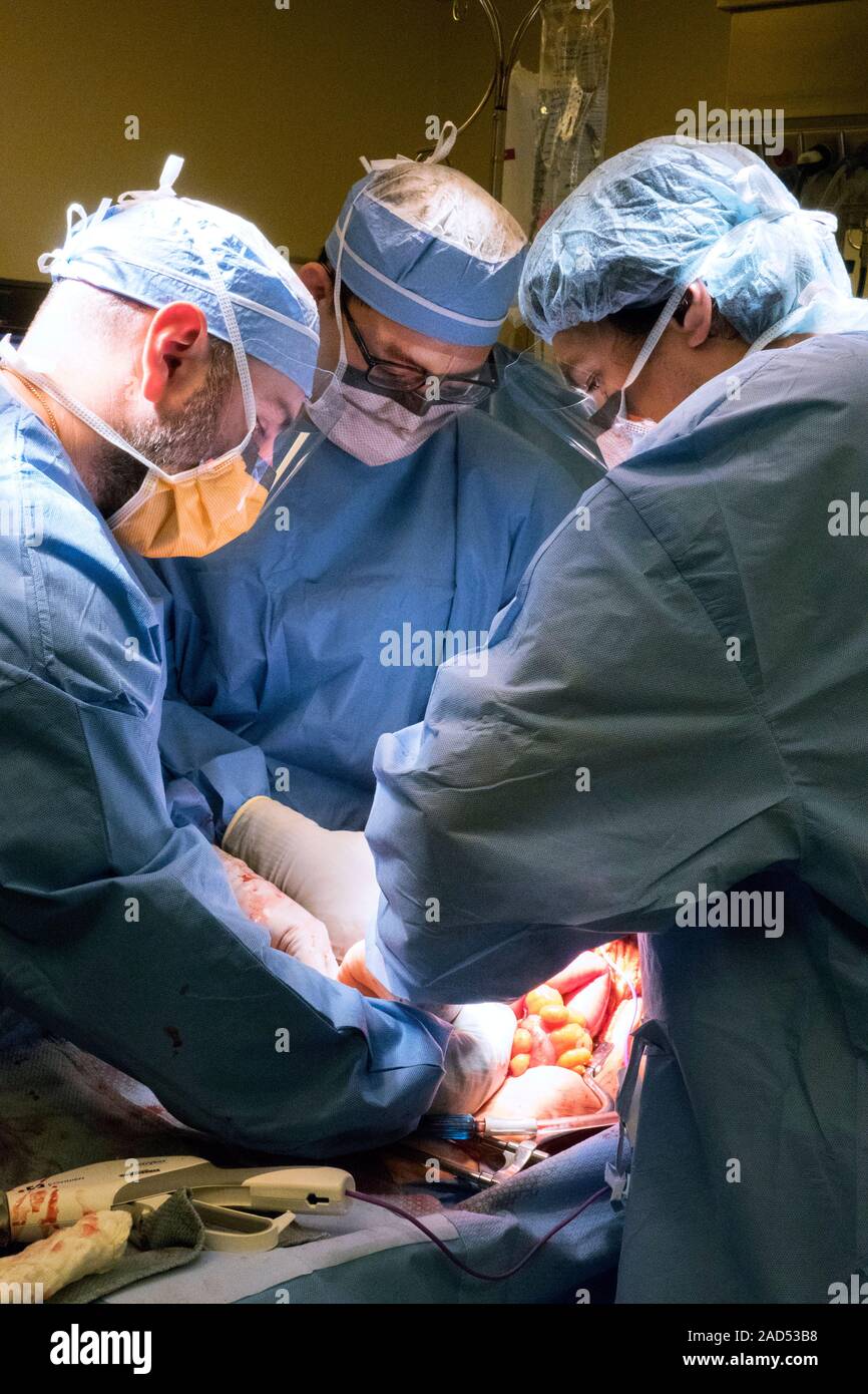 Bowel surgery. Surgeons performing an exploratory laparotomy to examine