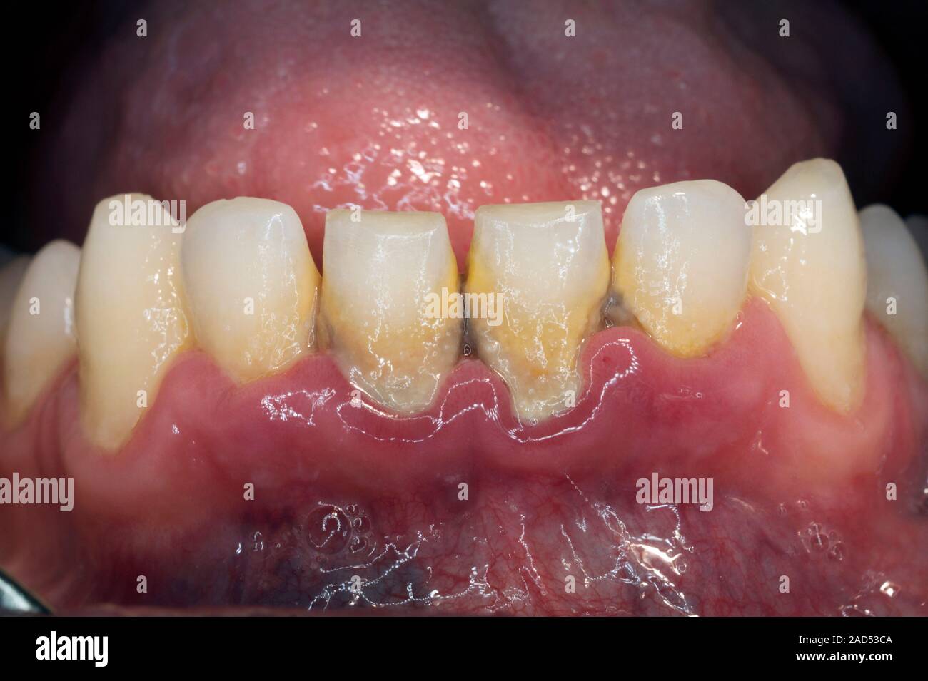 Tartar on teeth. Close-up of the lower teeth of a 24-year-old man ...