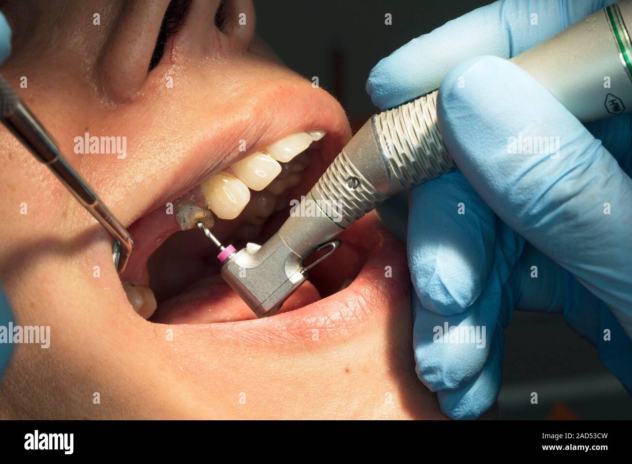 Root canal surgery. Closeup of a dentist performing root canal surgery