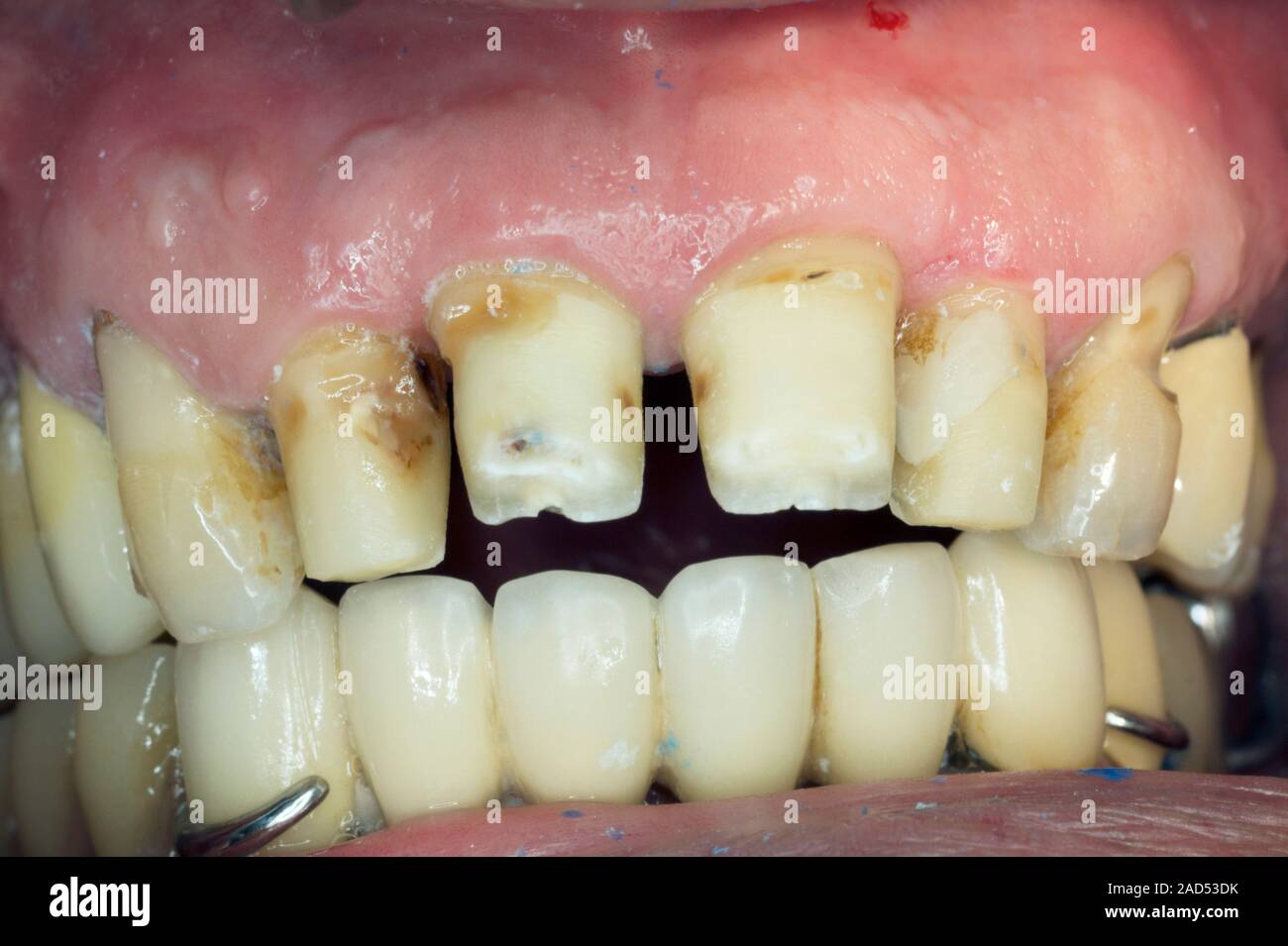 Tooth decay. Closeup of the teeth of a patient, showing the upper
