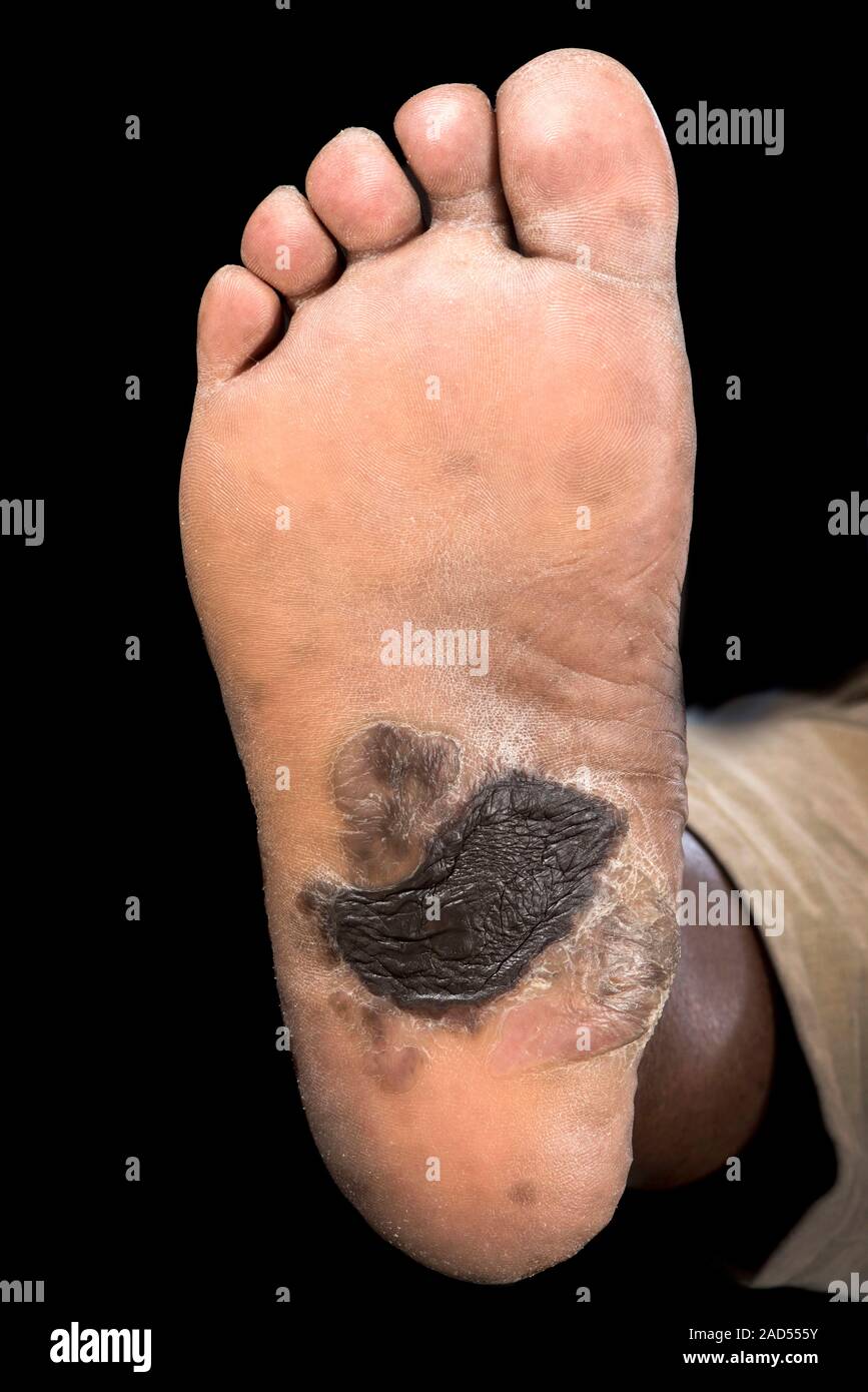 Keloid on the sole of the foot of a 68-year-old black male patient. A ...