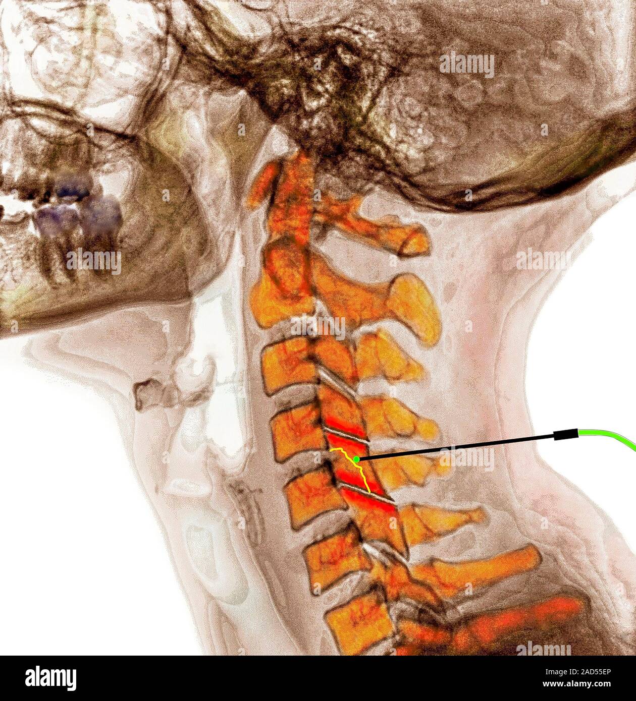 Spinal facet joint nerve ablation. Coloured lateral Xray of the bones