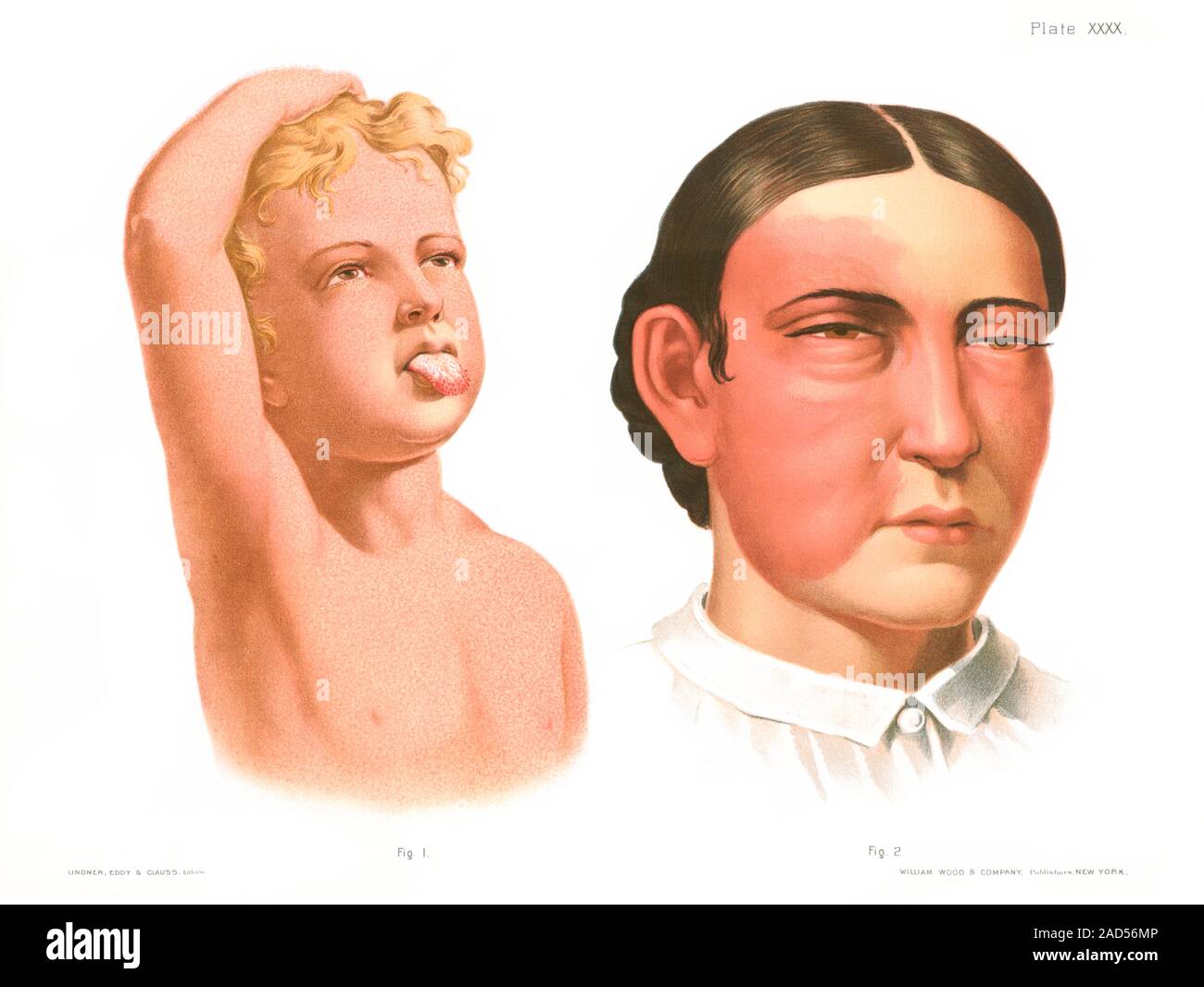 Scarlet fever rash (left) and erysipelas rash (right), historical ...