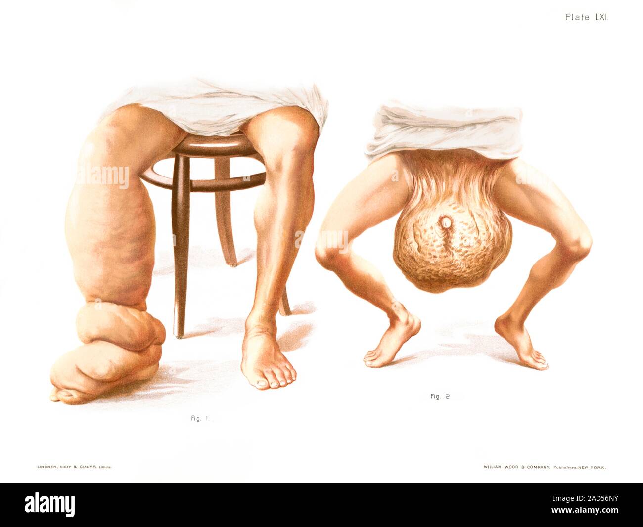 Elephantiasis. Historical medical illustration of severe elephantiasis (lymphatic filariasis) affecting the leg and the scrotum. This condition is cau Stock Photo
