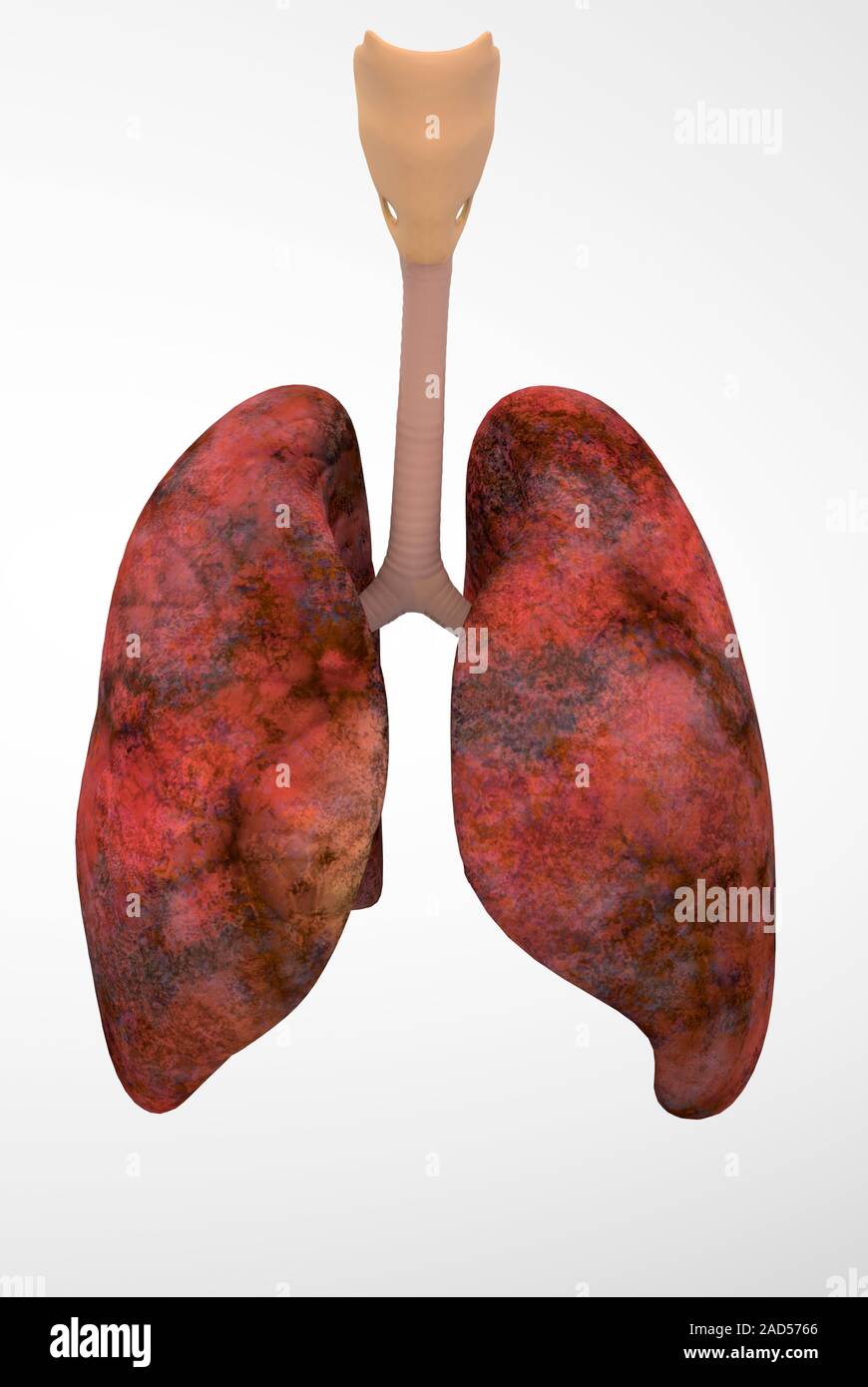 Smoker's lungs. Illustration of lungs severely damaged by smoking. At top is the voicebox and