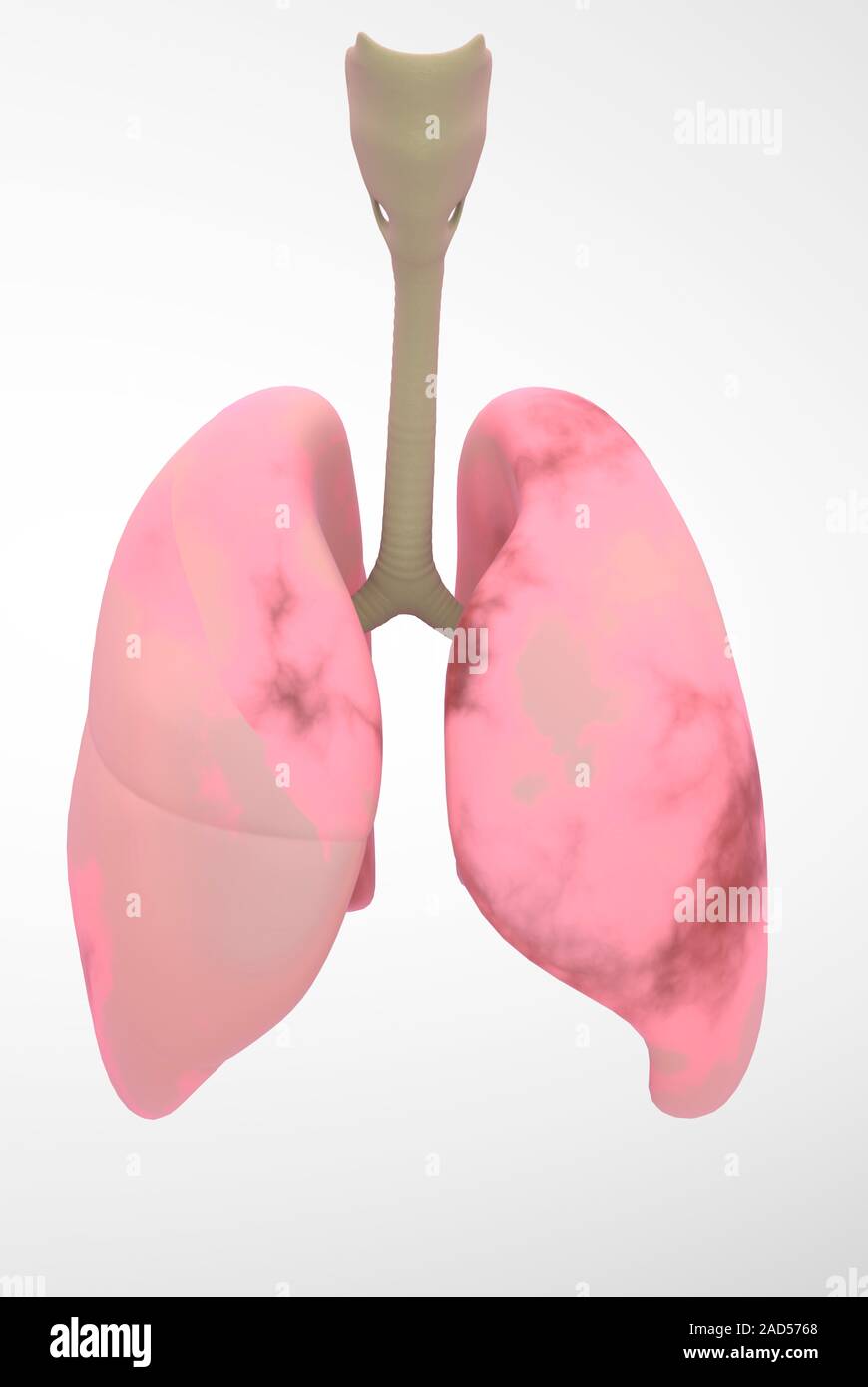 Smoker's lungs. Illustration of lungs partially damaged by smoking. At top is the voicebox and