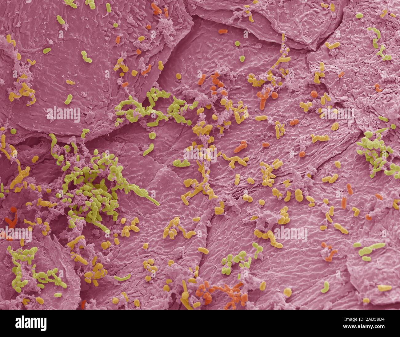 Bacterial skin infection. Coloured scanning electron micrograph (SEM ...