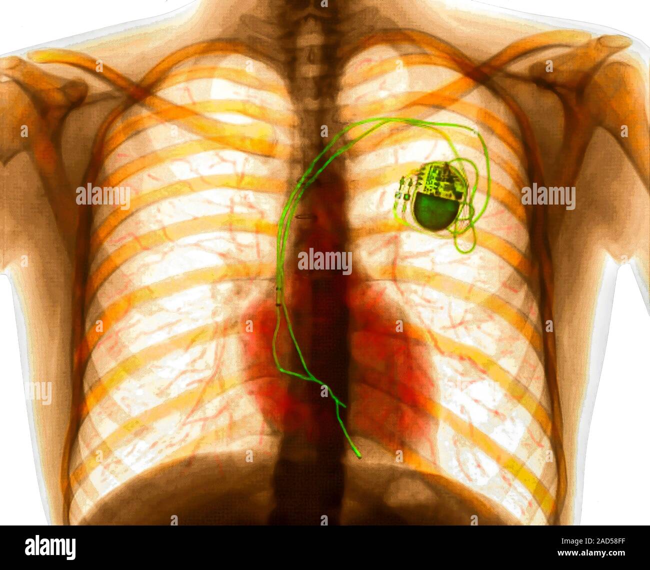 Cardiac pacemaker. Coloured chest X-ray showing an implanted cardiac ...
