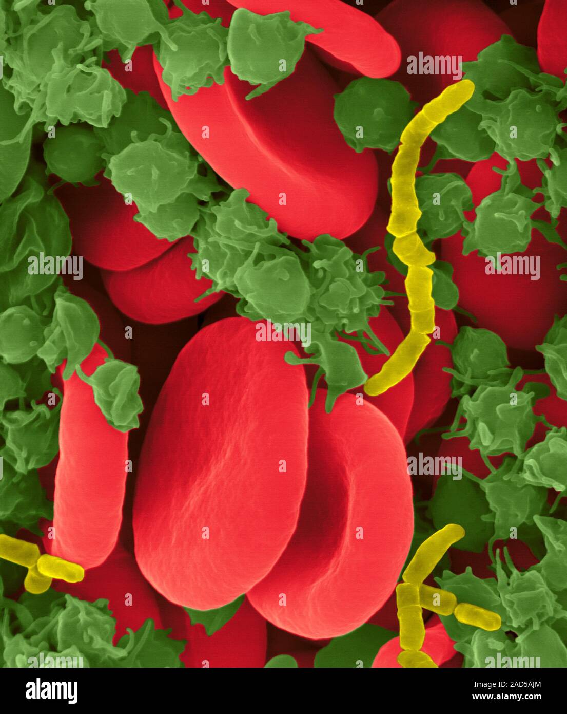 Bacterial blood infection caused by a rod shaped bacterium, composite