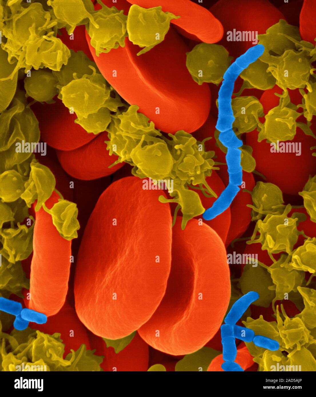 Bacterial blood infection caused by a rod shaped bacterium, composite