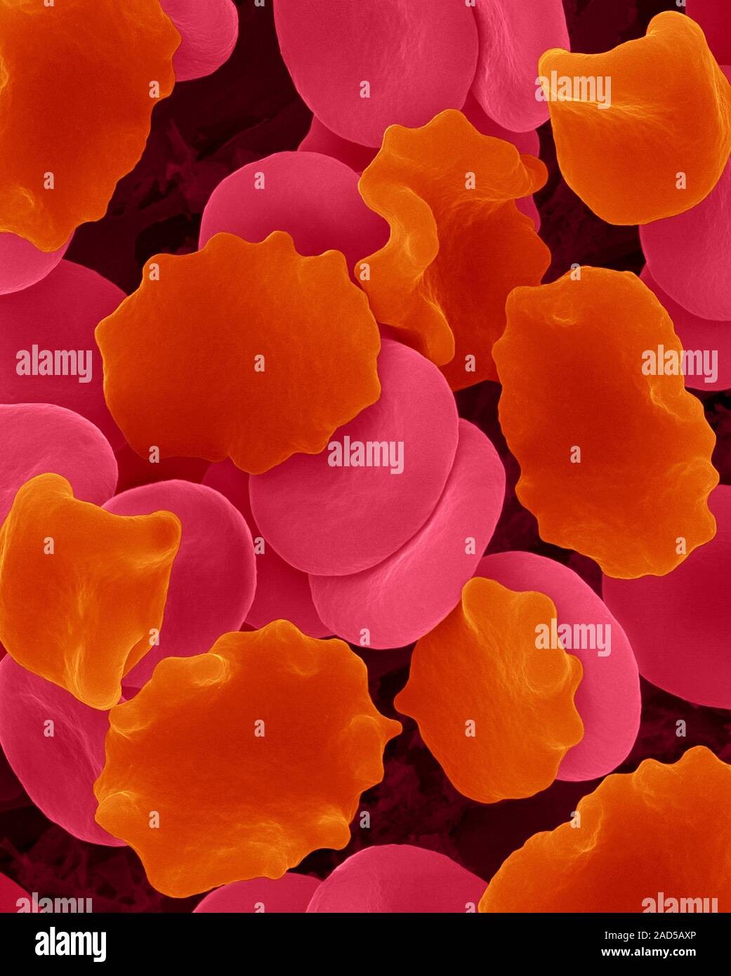 Human red blood cells in hypertonic solution (1.01% NaCl), coloured ...