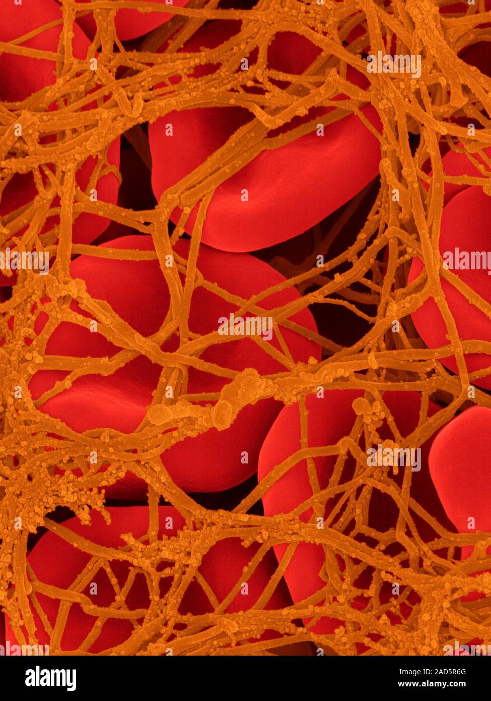Coloured scanning electron micrograph (SEM) of a blood clot (menstrual