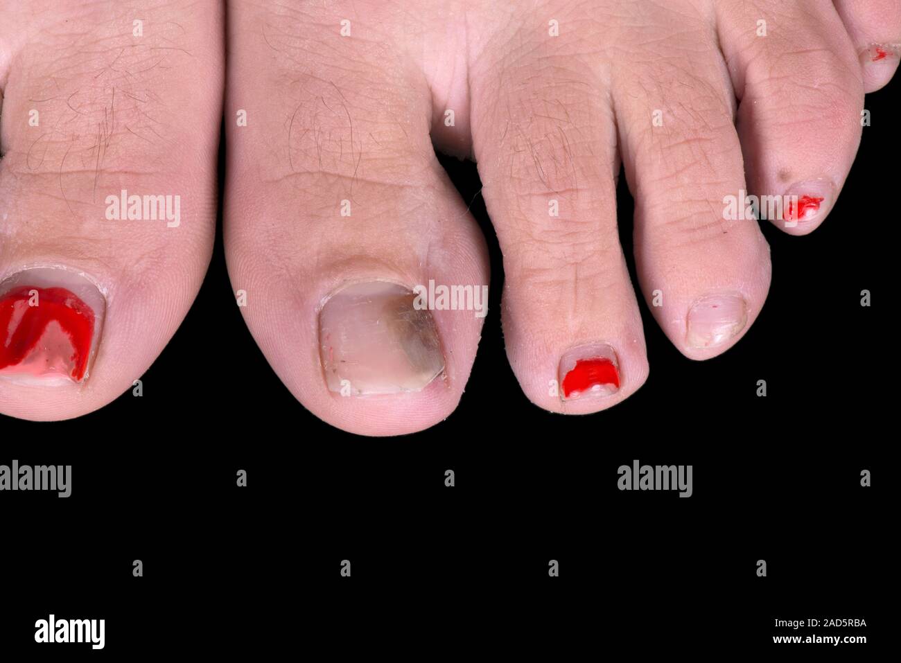 Subungual haematoma (grey area) on the big toe of the left foot of a 28