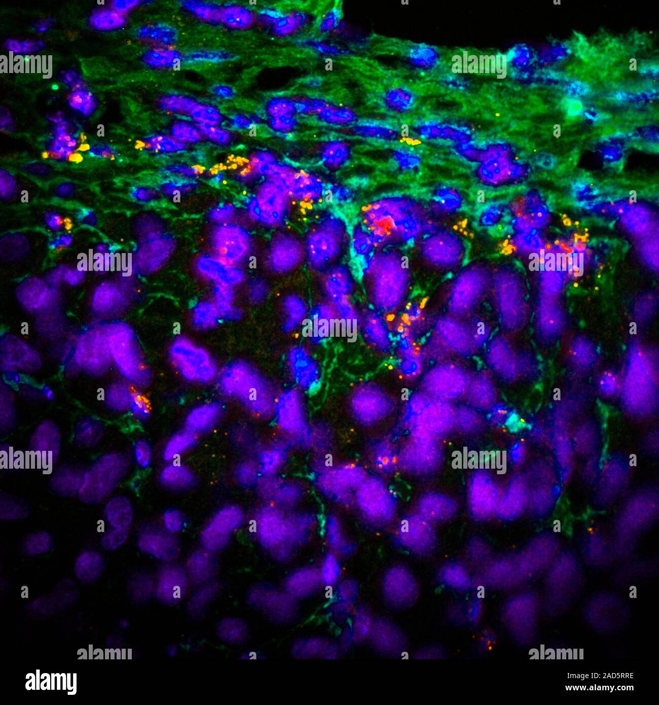 Nanoparticle cancer treatment research. Image showing hybrid ...