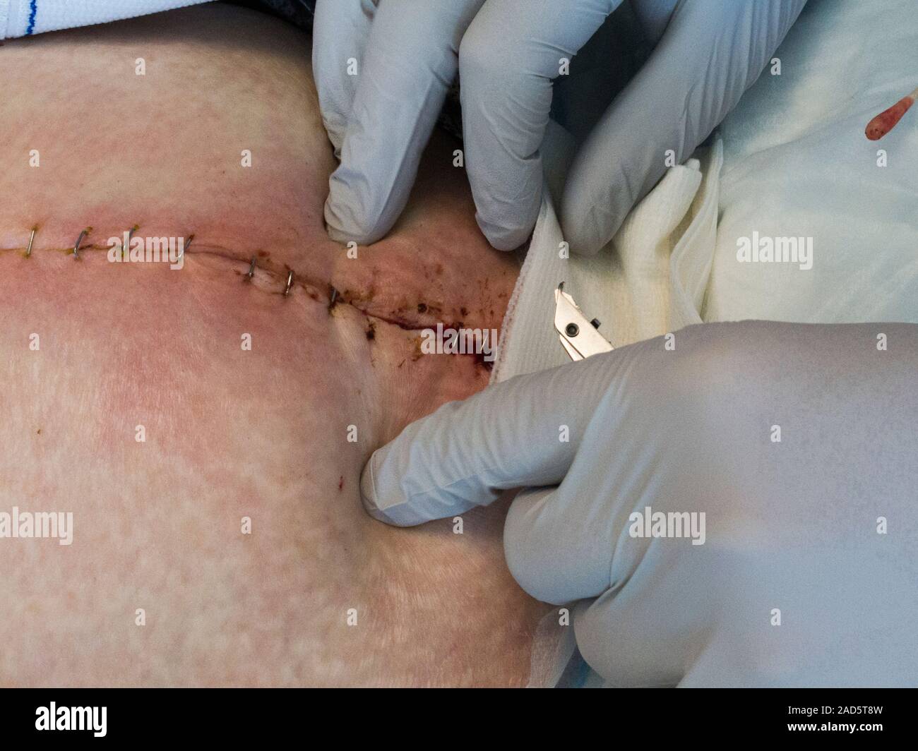 Cleaning infected surgical wound. Doctor using a staple remover to open the skin at the site of