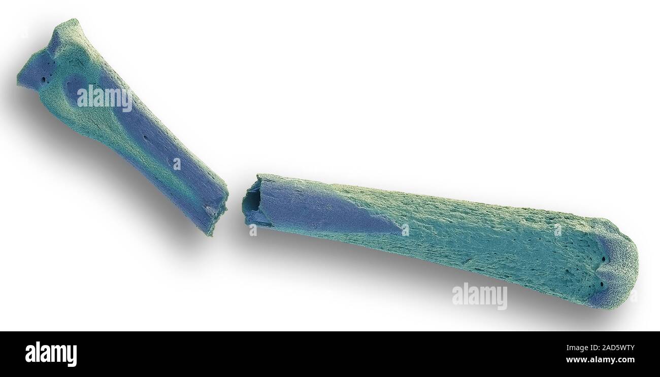 Osteoporotic bone. Coloured scanning electron micrograph (SEM) of a bone affected by