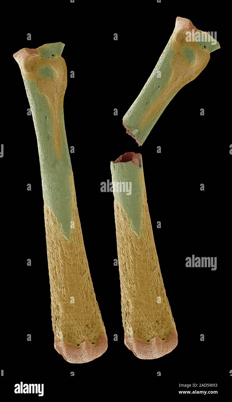 Osteoporotic bones. Coloured scanning electron micrograph (SEM) of bones affected by