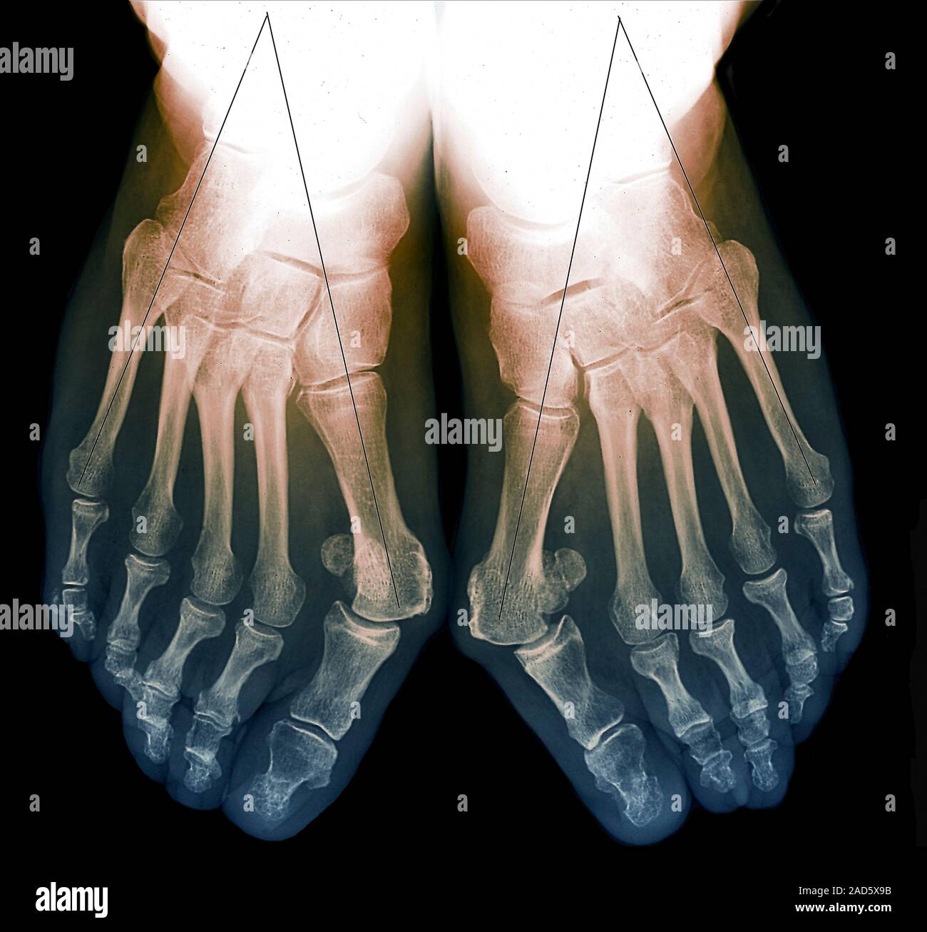 Bunion assessment. Coloured Xrays showing a 70yearold woman's feet