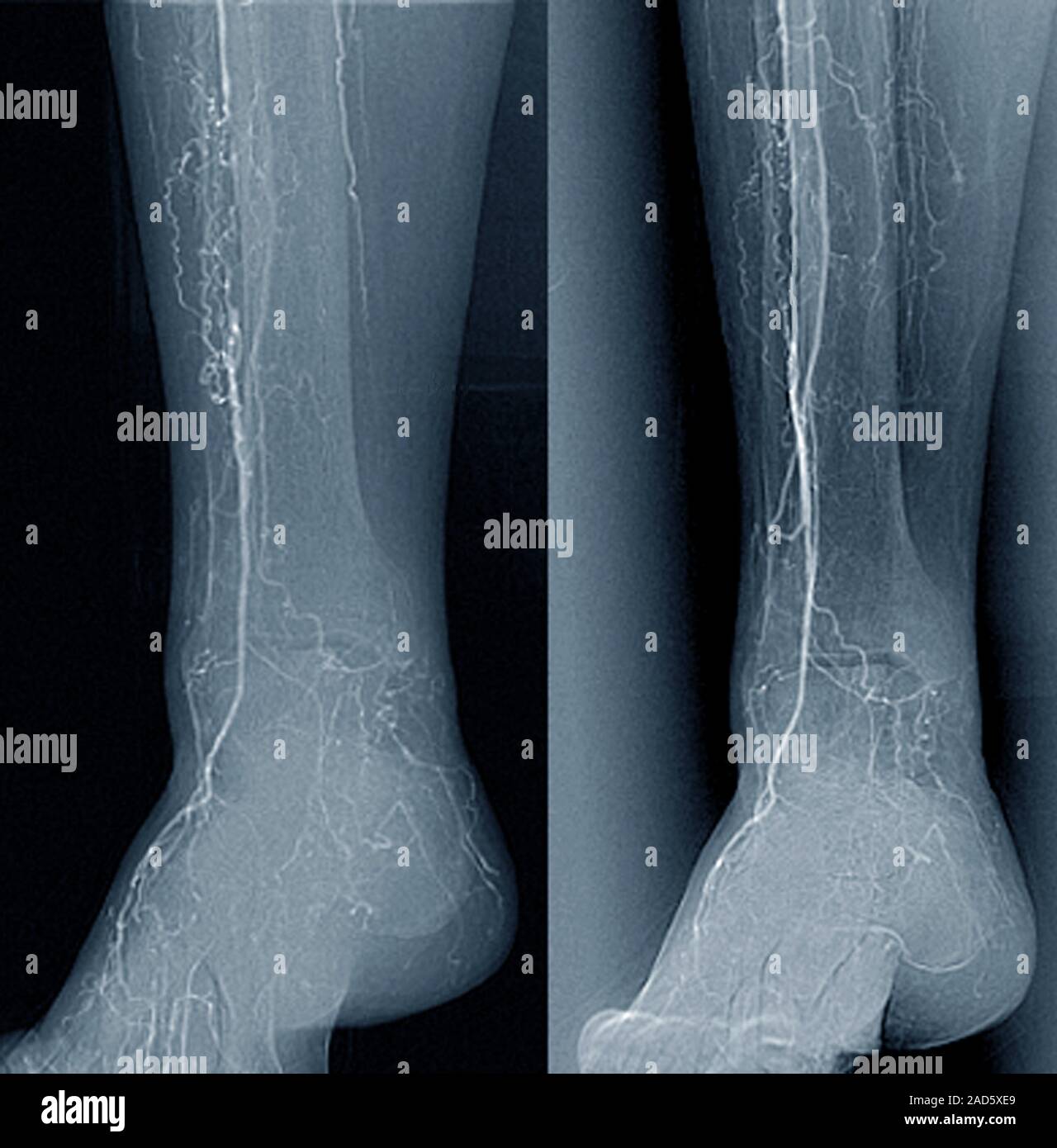 Angiogram In Leg Treatment for blocked leg arteries. Coloured angiograms (blood vessel X ...