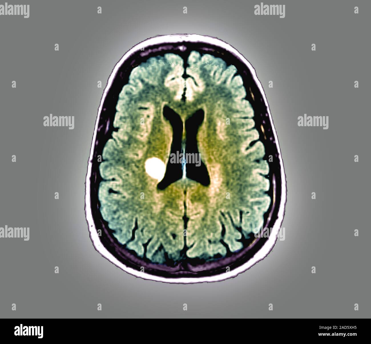 Multiple sclerosis. Axial magnetic resonance imaging (MRI) scan of the ...