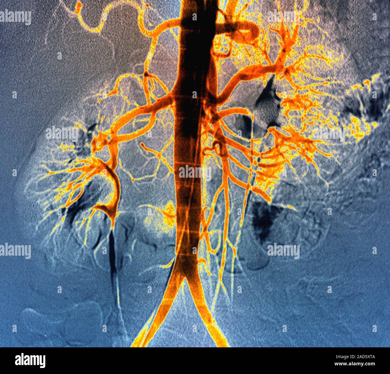 Kidney blood vessels. Coloured angiogram (blood vessel Xray) of the normal arterial blood