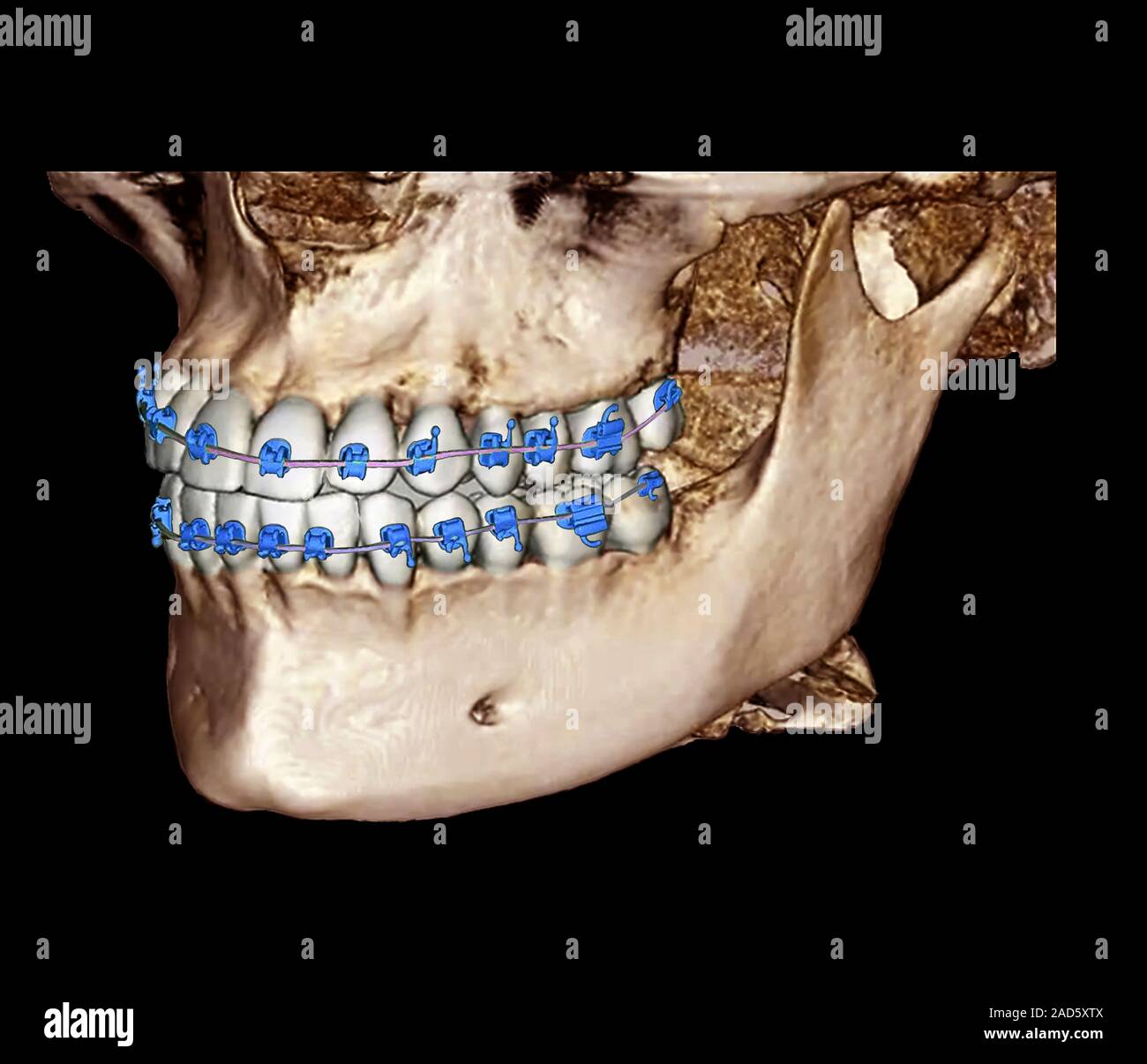 Orthodontic braces. 3D cone beam computed tomography (CBCT) scan of the