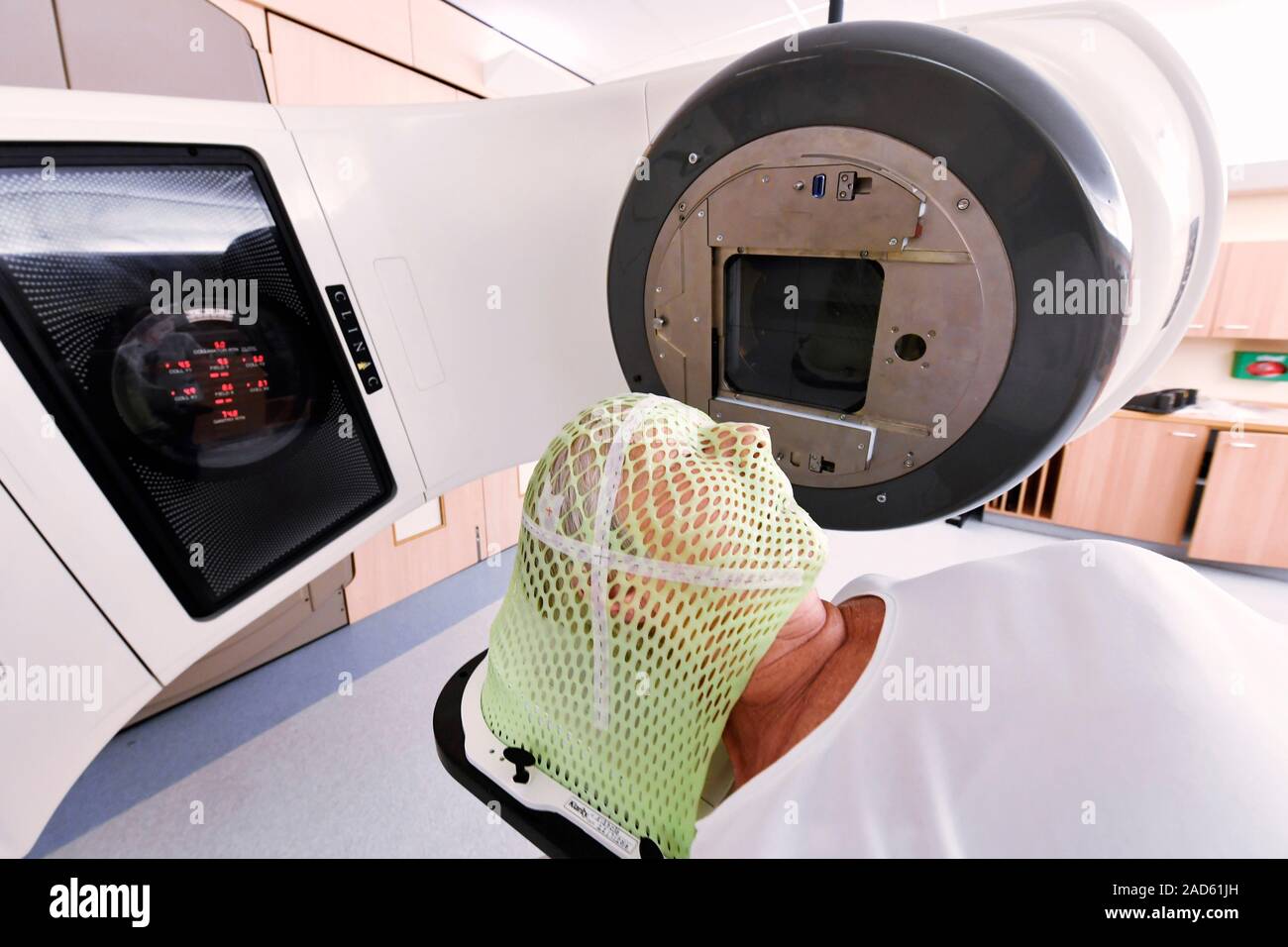 Brain cancer radiotherapy. 70-year-old woman with a malignant brain ...