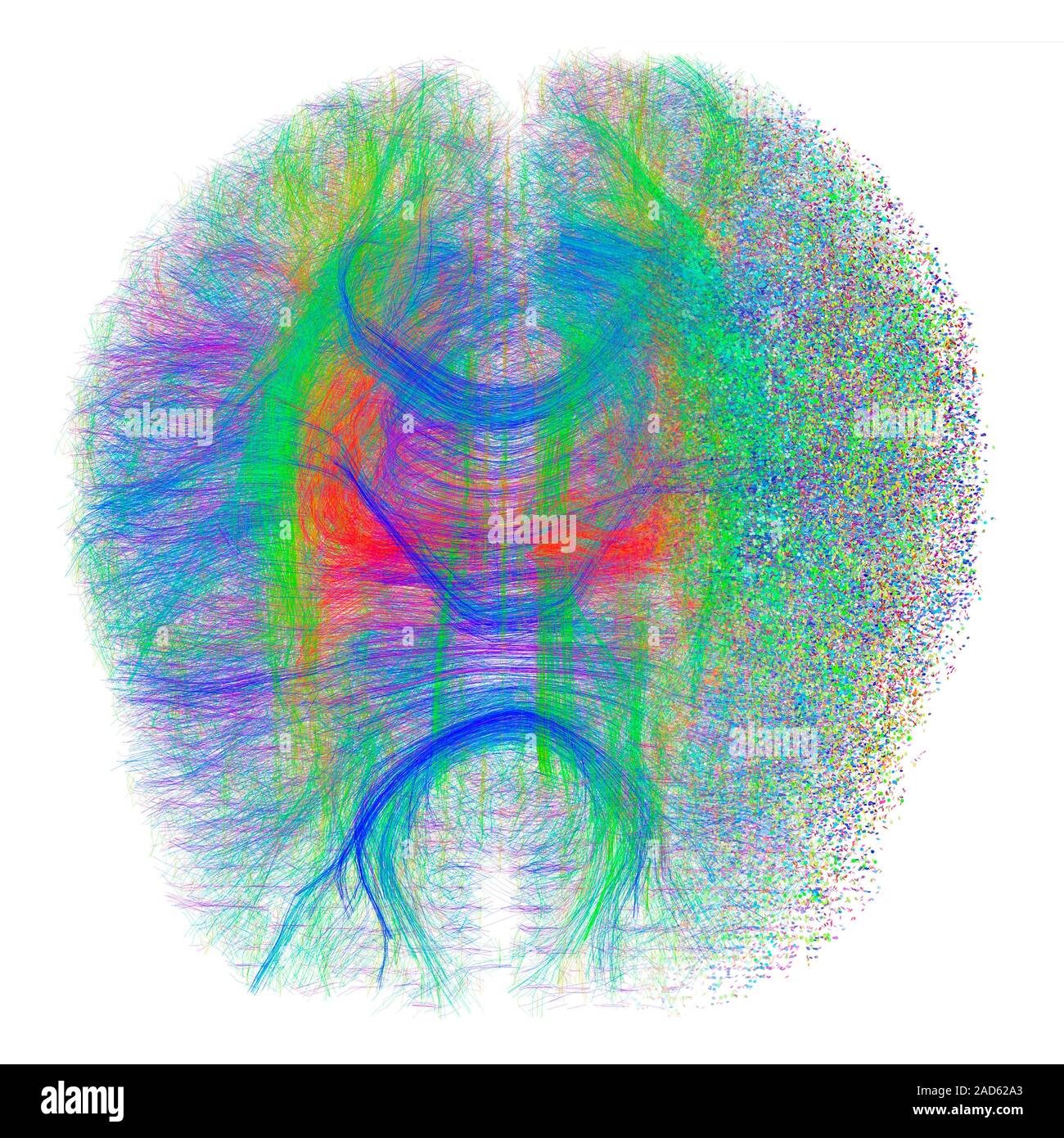 Computer artwort of white matter fibres dissolving on one side ...