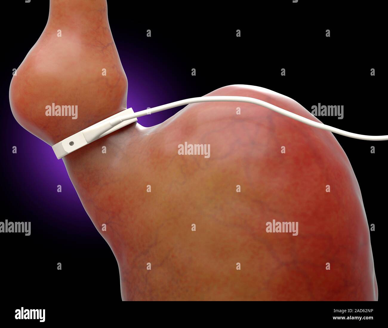 Illustration of gastric banding. A laparoscopic adjustable gastric band ...