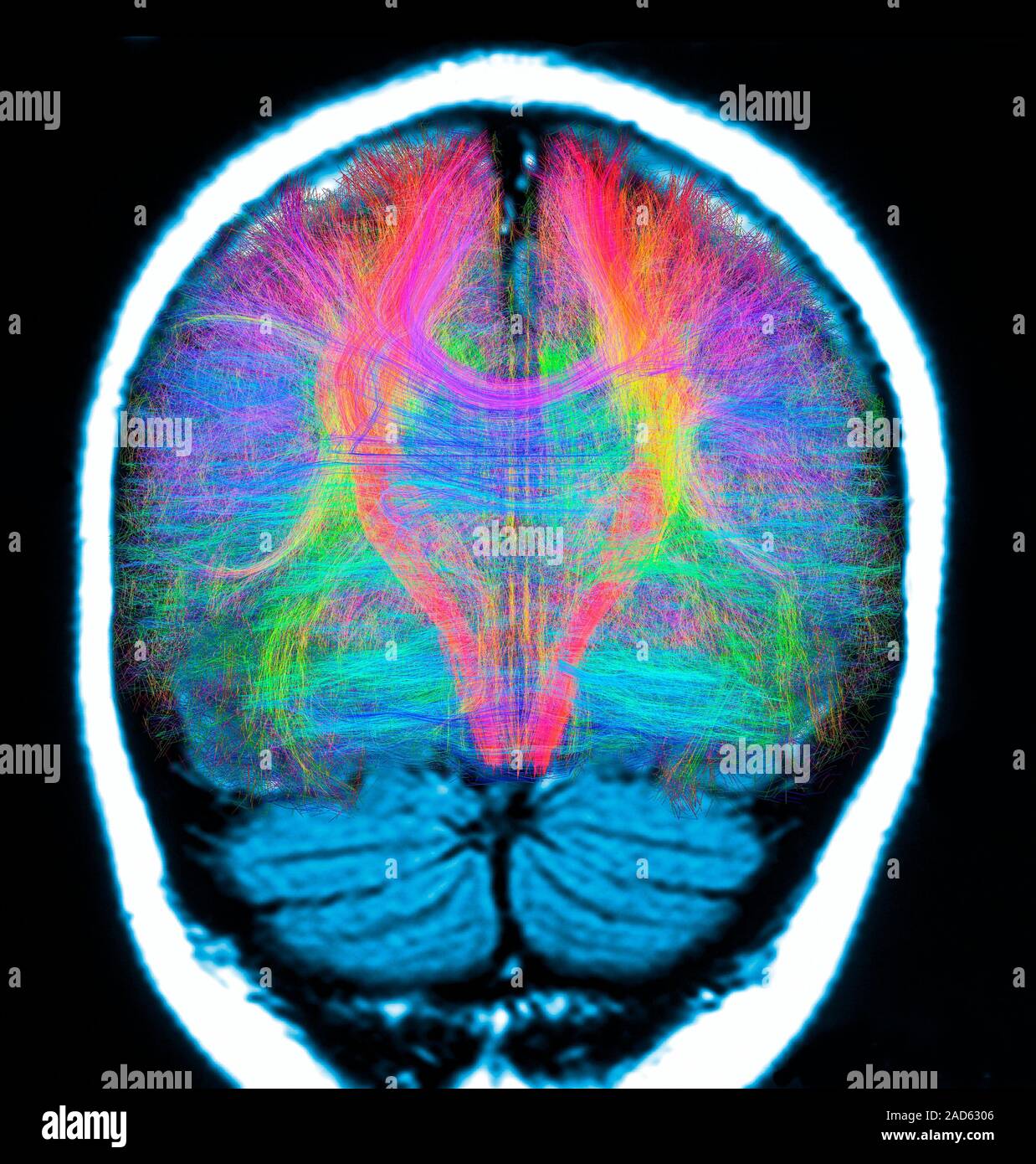 Computer artwork of a brain MRI frontal view overlaid with white matter ...