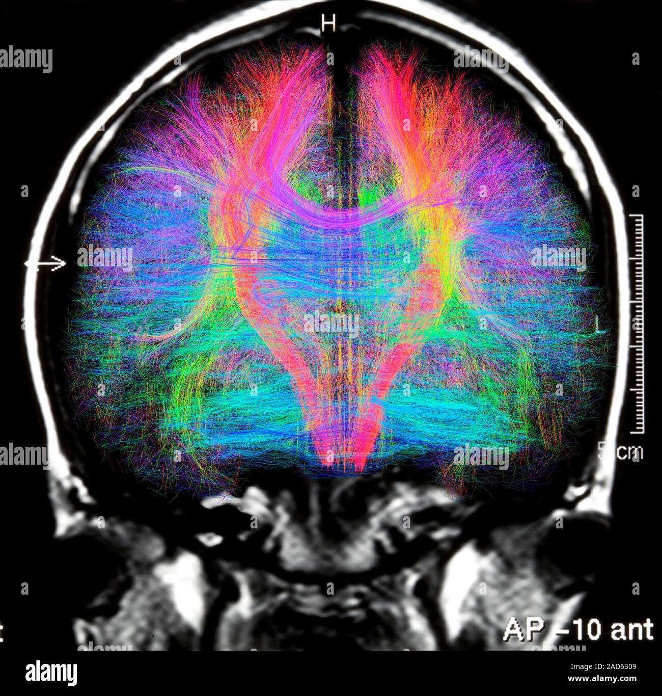 Computer artwork of a MRI frontal view of the brain showing white ...