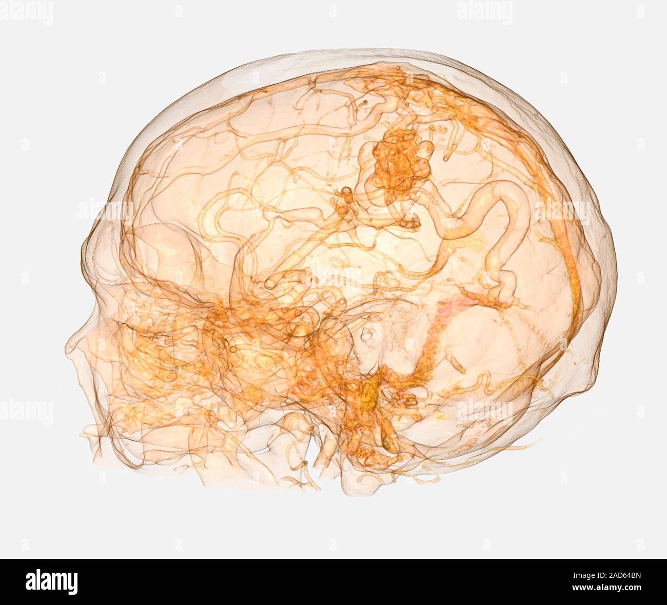 Cerebral arteriovenous malformation. Illustration based on a 3D ...