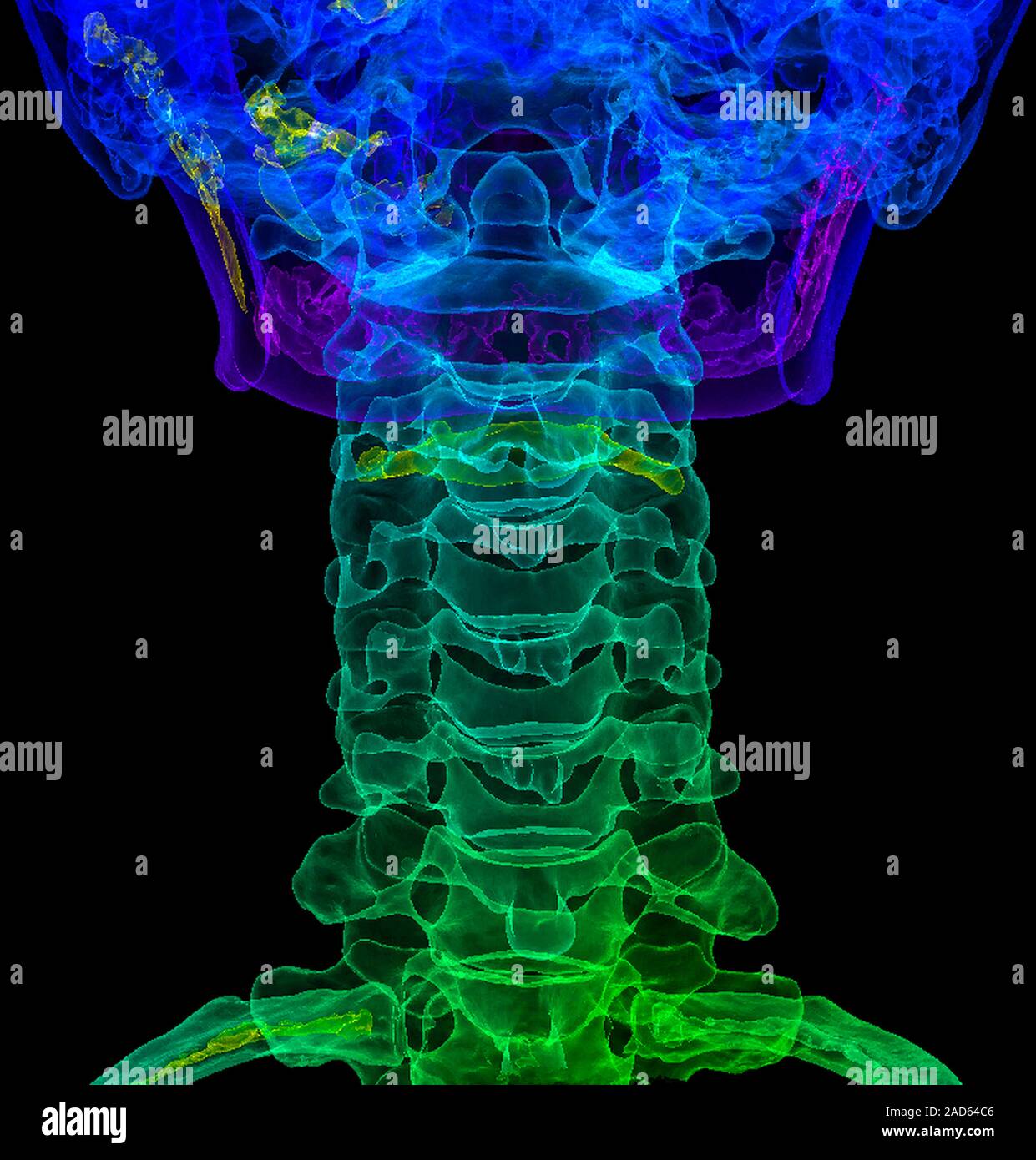 Cervical spine anatomy. Digitally enhanced 3D computed tomography (CT ...