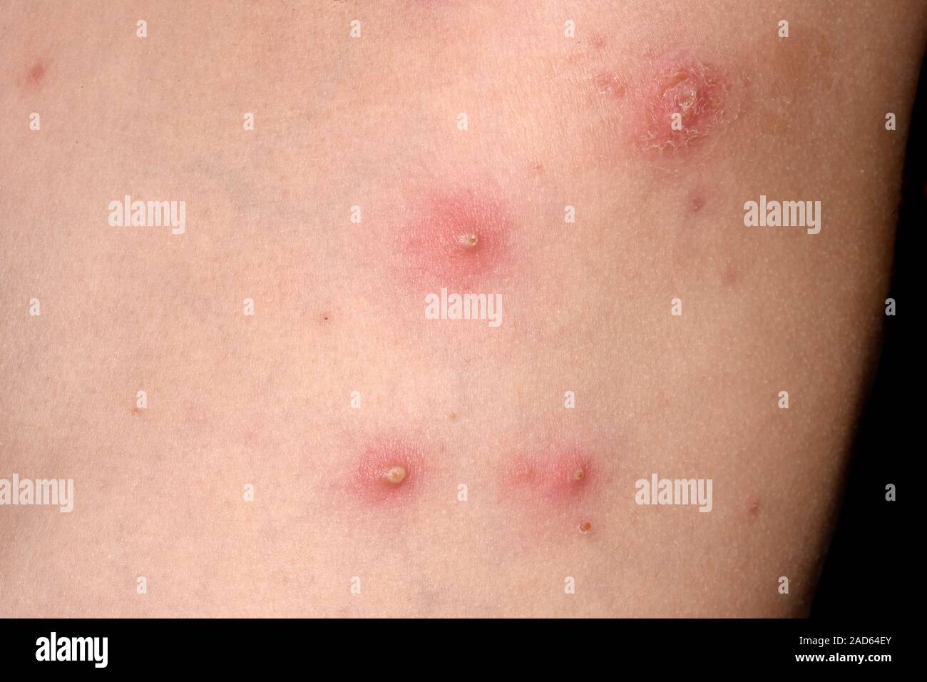 Folliculitis on the chest. Closeup of infected and inflamed hair