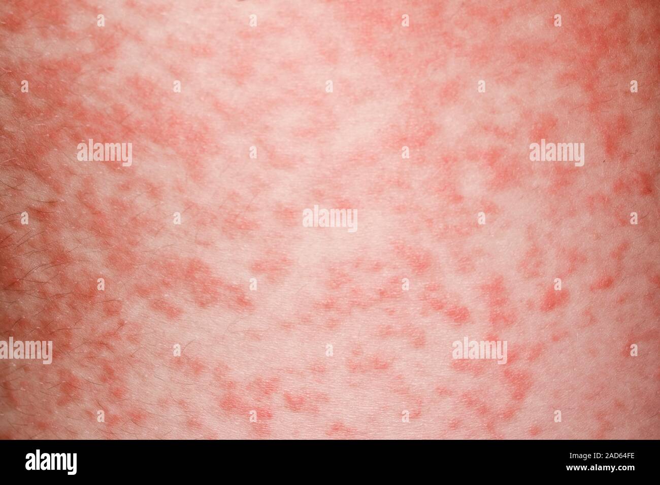 Rash in glandular fever treatment. Close-up of a rash on the skin of a