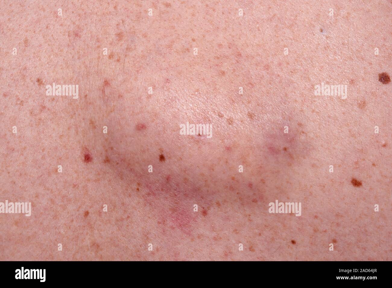 Sebaceous Cyst Close Up Of A Sebaceous Cyst On A Year Old Male Patient S Back A Sebaceous