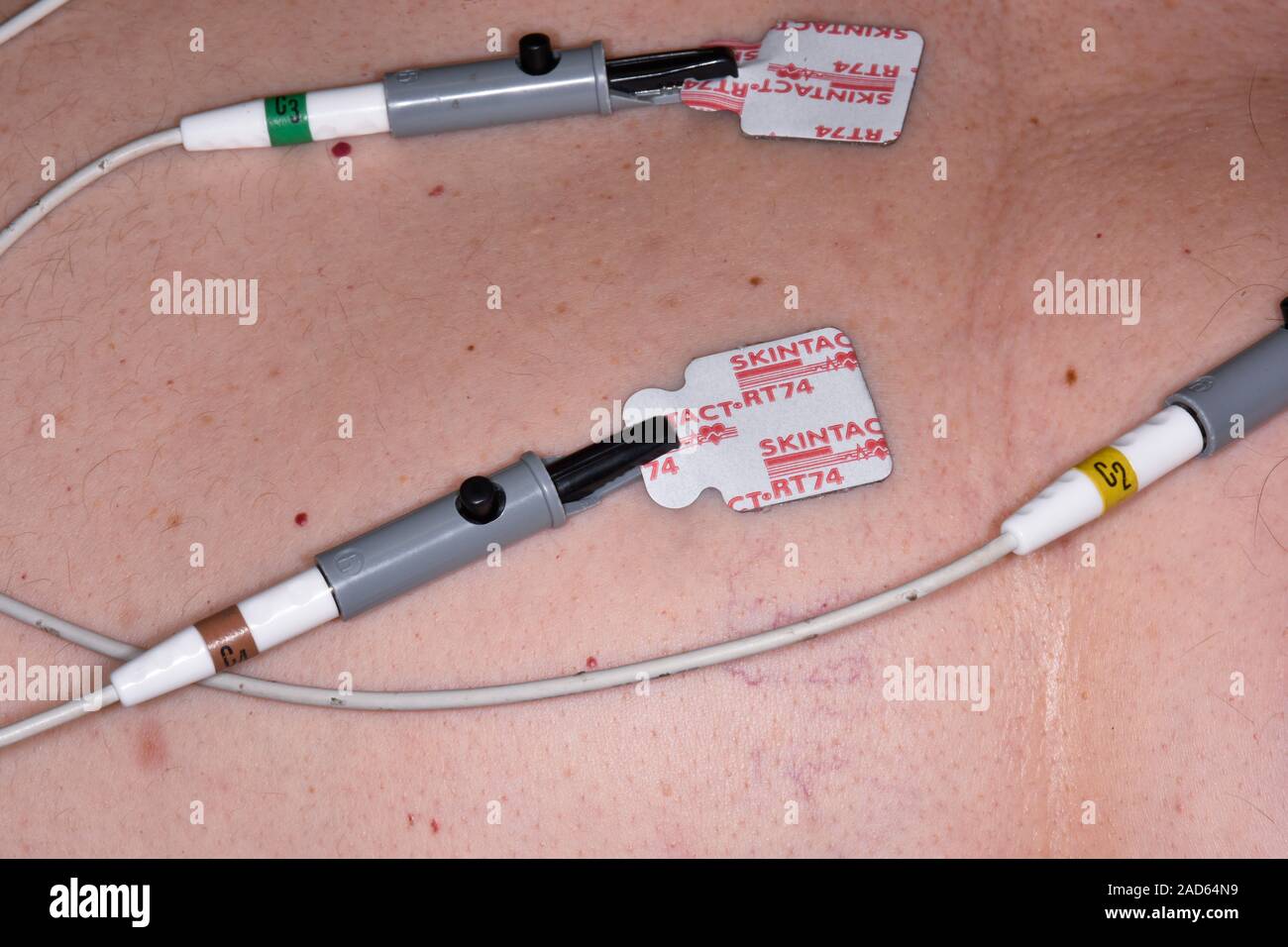 ECG leads. Closeup of electrodes on the skin of a patient undergoing