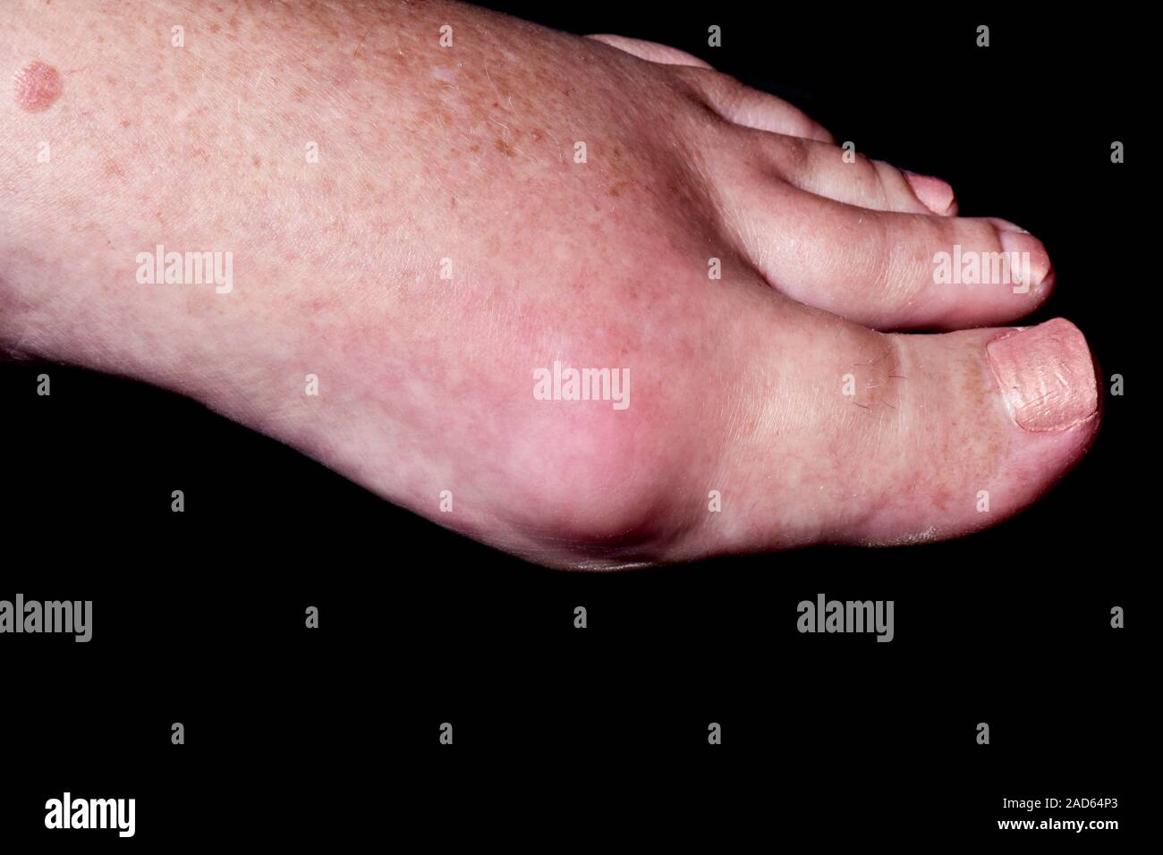 Swollen foot in gout. Closeup of the reddened swollen foot of a 65