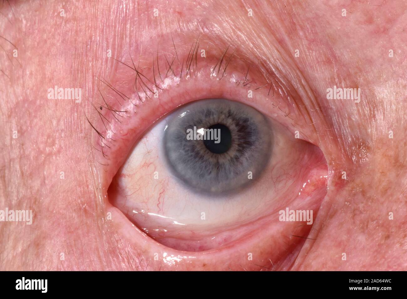 Paint in eye. Closeup of a fleck of paint (small, white, upper centre