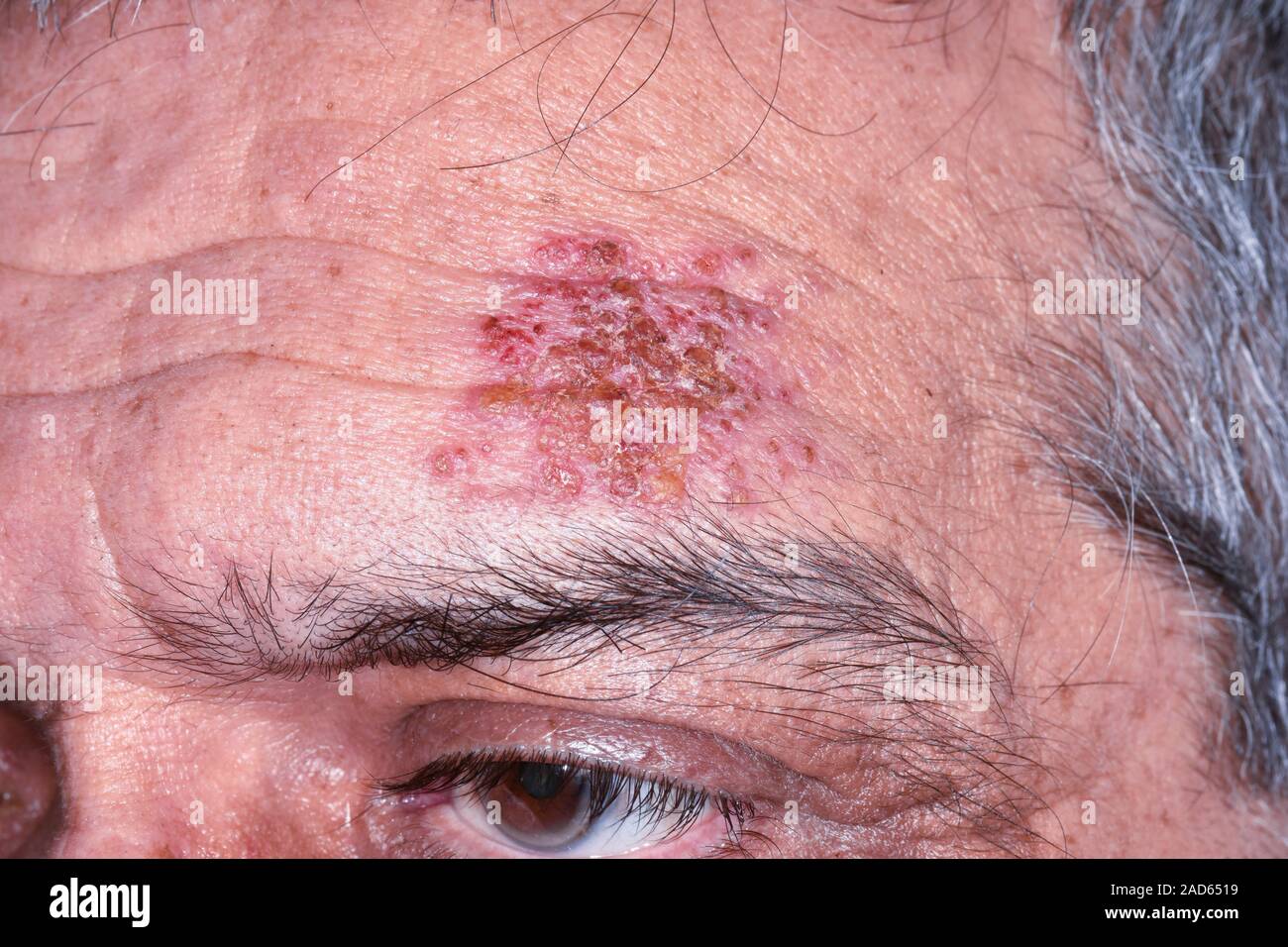 Shingles rash. Closeup of a rash on the forehead of a 62yearold male