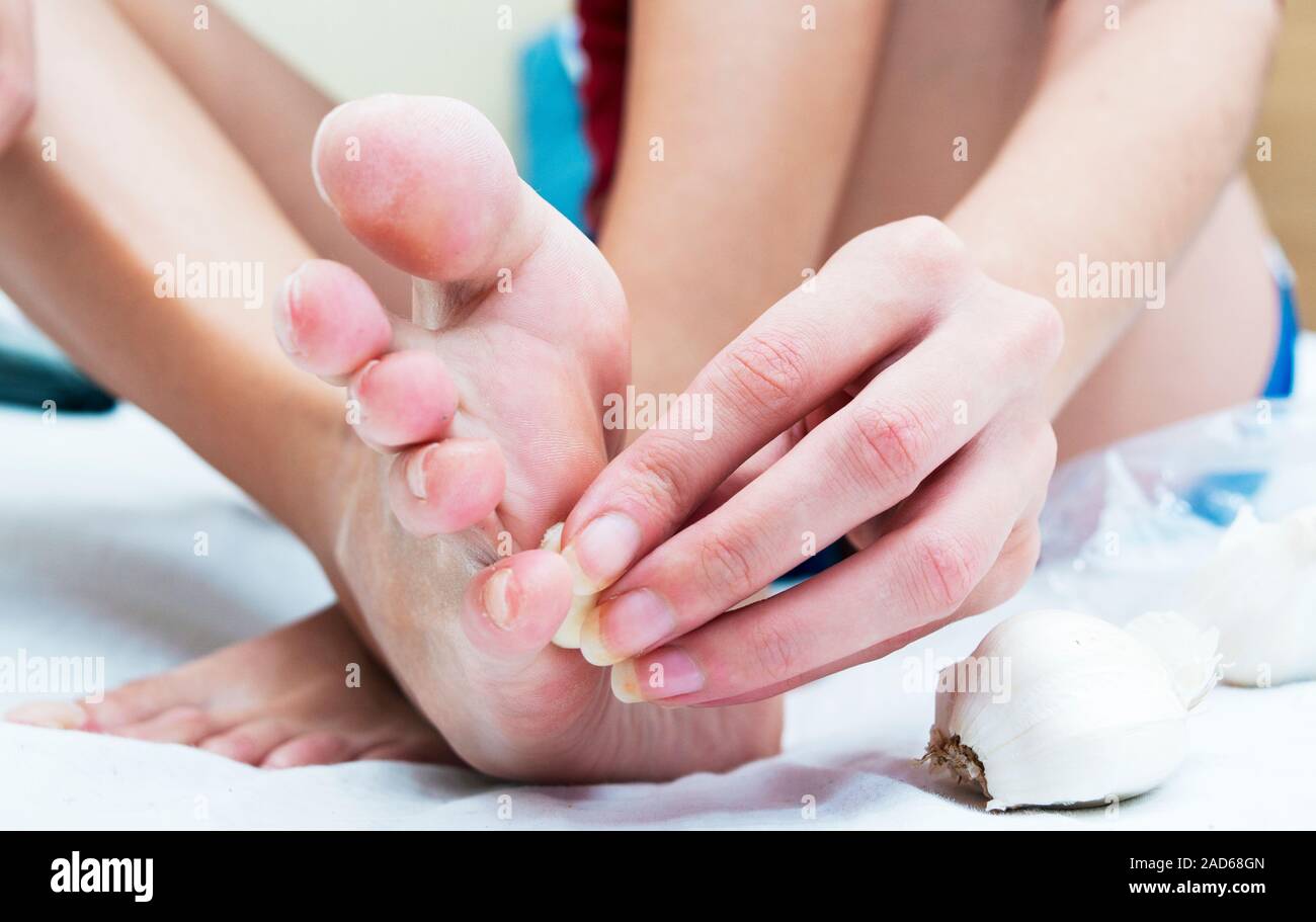 Homemade or alternative, natural treatment with garlic for verruca or plantar ward Stock Photo