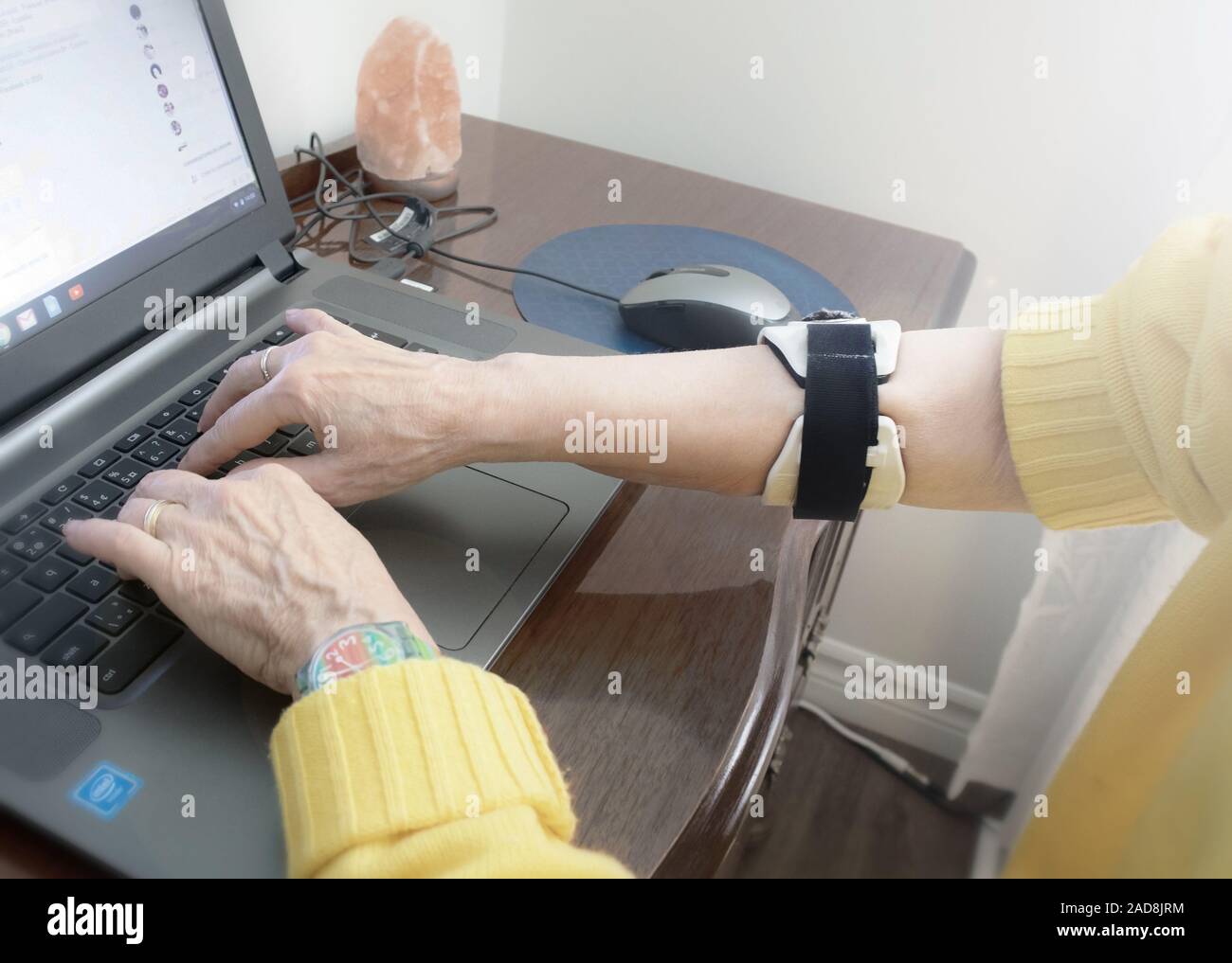 The hands of a mature woman working on a laptop. She wears a forearm band. Stock Photo