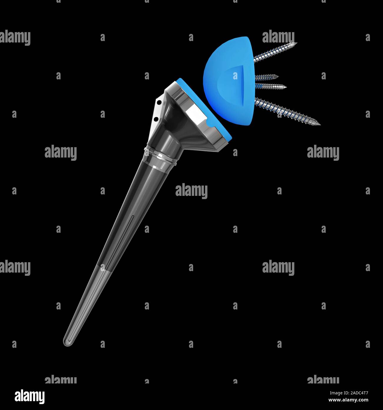 Artificial shoulder joint. Computer illustration of a prosthetic implant used in a total