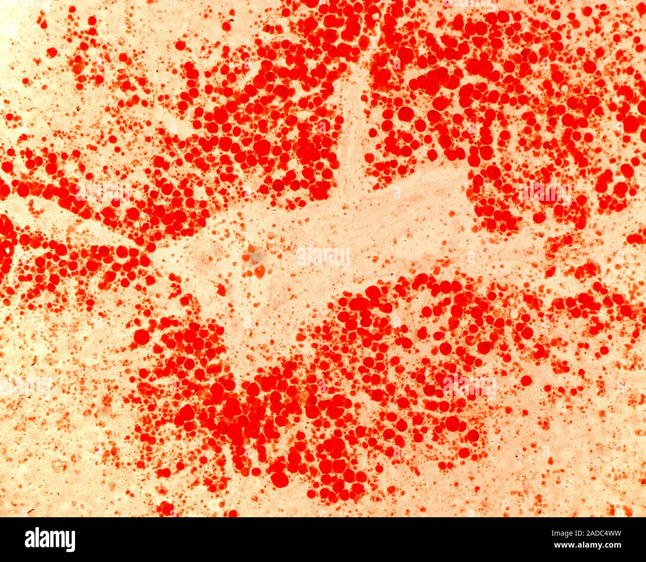 Light micrograph of a fatty liver (steatosis) stained with oil red O to ...