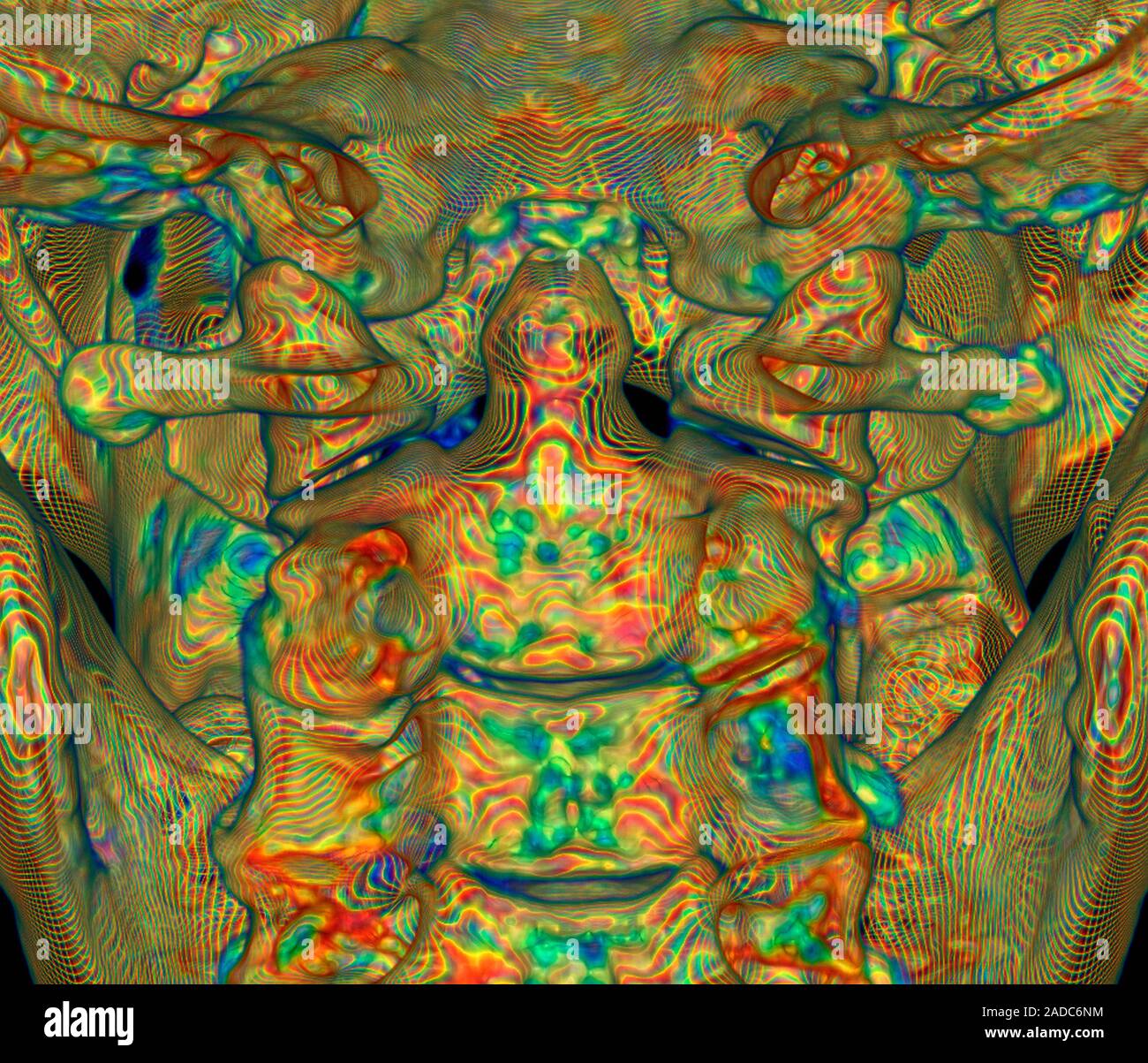 Upper cervical spine. Digitally enhanced 3D computed tomography (CT ...