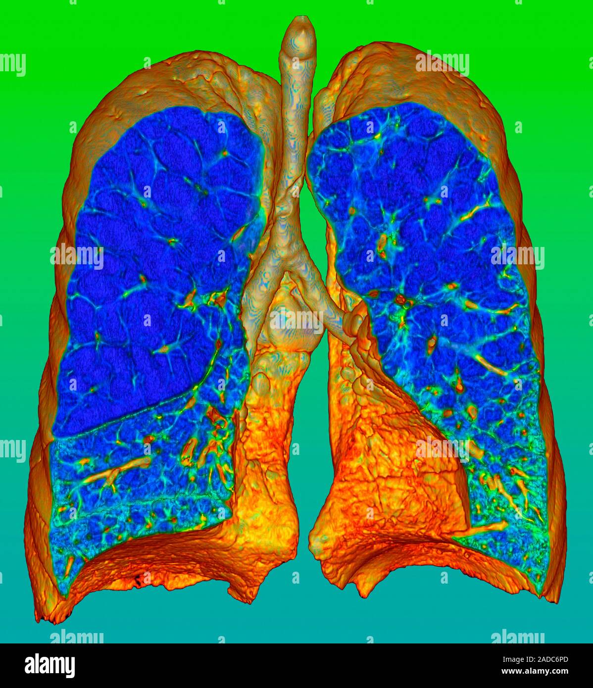 National Emphysema Foundation - THE LUNG Australia
